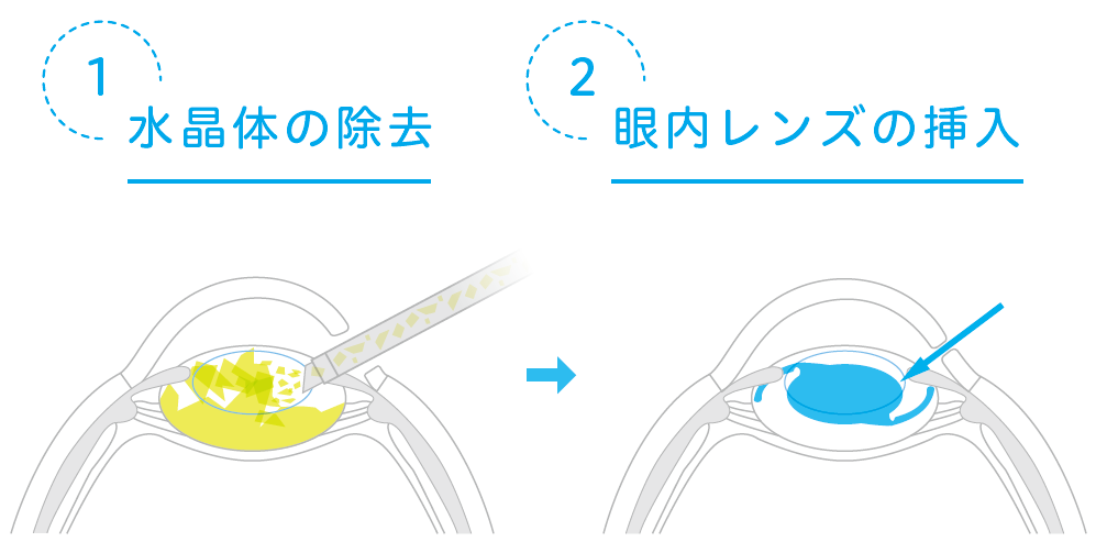 水晶体の除去とと眼内レンズの挿入