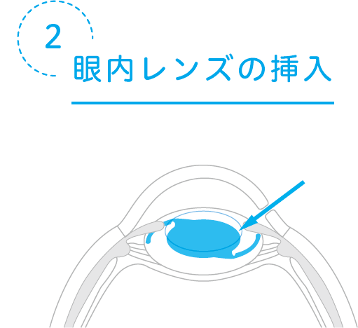 眼内レンズの挿入